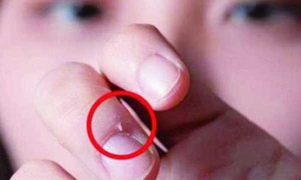 手起倒刺吃什么維生素,手指上長(cháng)倒刺是因為缺乏維生素嗎圖1