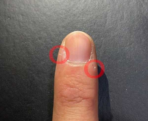 手起倒刺吃什么維生素,手指上長(cháng)倒刺是因為缺乏維生素嗎圖2