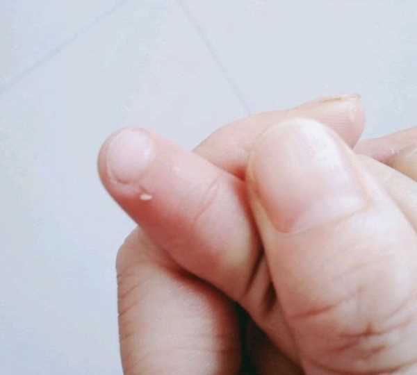 手起倒刺吃什么維生素,手指上長(cháng)倒刺是因為缺乏維生素嗎圖3