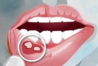 交泰丸治療反復口腔潰瘍