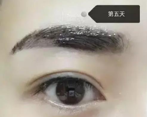 紋眉幾天可以恢復自然