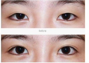 雙眼皮吸脂方法有哪些方法有哪些方法