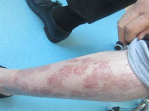 長(cháng)春有治療銀屑病的醫院有哪些方法是什么