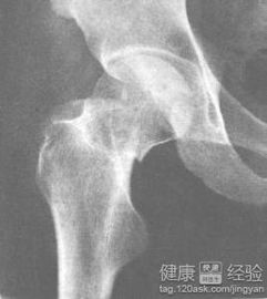 股骨頸骨折手術(shù)治療方法有哪些方案