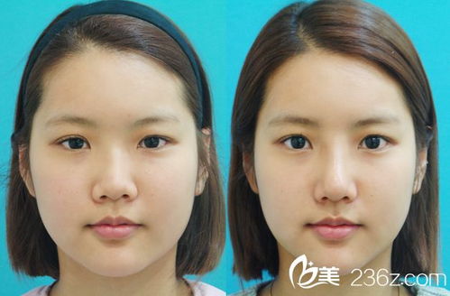 縮小鼻翼的正確方法有哪些