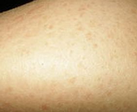 魚(yú)鱗病的手護理方法有哪些