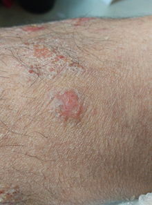 皮炎治療的好方法都有哪些