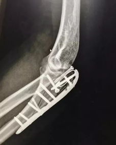 什么是粉碎性骨折 (什么是疲勞性骨折 )