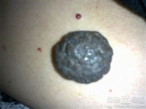 黑色素瘤飲食注意事項,黑色素瘤術(shù)后注意事項,懷疑黑色素瘤活檢注意事項