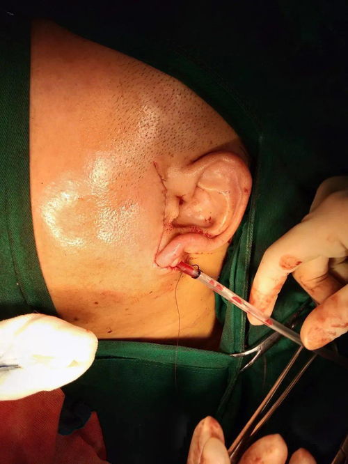 腮腺,注意事項,瘤術(shù)中