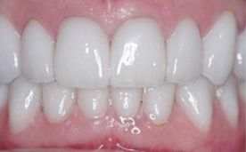 注意事項,烤瓷牙