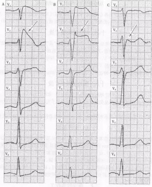描記心電圖時(shí)的注意事項