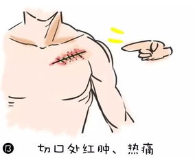 起搏器,術(shù)后,注意事項