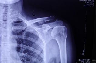 肩鎖關(guān)節脫位保守治療及注意事項