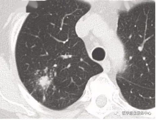 引流,肺部,注意事項