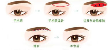 兒童上瞼下垂手術(shù)后注意事項