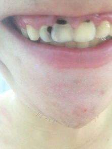 撥門(mén)牙要注意事項