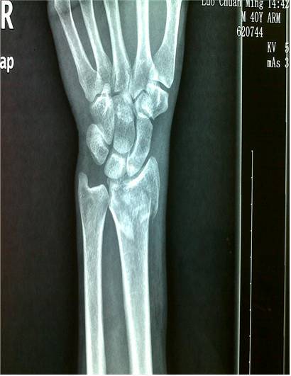 橈骨遠端骨折注意事項