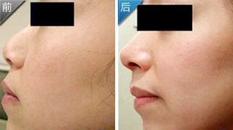 尿酸,注意事項,鼻子