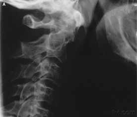 脖子骨折睡覺(jué)注意事項