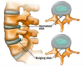 腰椎間盤(pán)突出癥患者注意事項
