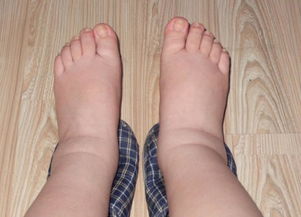 雙下肢浮腫注意事項