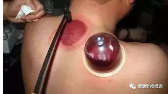 穿刺,注意事項,優(yōu)點(diǎn)