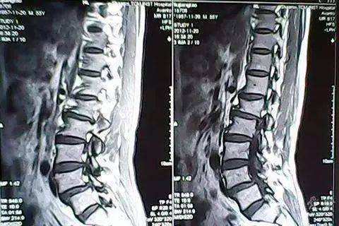 造影術(shù)前術(shù)后注意事項,心臟造影術(shù)后注意事項,腦血管造影術(shù)后注意事項