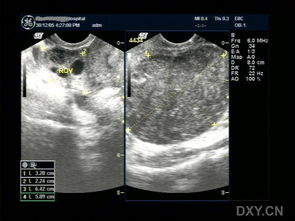 子宮左側包塊手術(shù)后注意事項