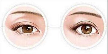 雙眼皮吸脂注意事項