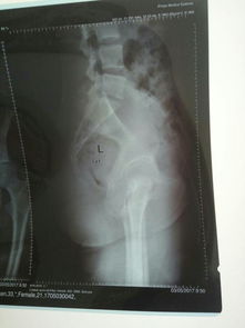 尾骨骨裂注意事項