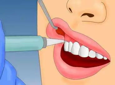 心臟病拔牙注意事項