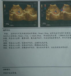 肝臟,注意事項,彩超