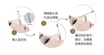 線(xiàn)雕鼻子后的注意事項,線(xiàn)雕鼻子注意事項有哪些,鼻子做線(xiàn)雕的注意事項