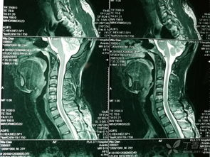 頸椎骨折翻身注意事項,頸椎骨折牽引翻身注意事項,頸椎骨折病人翻身時(shí)注意事項