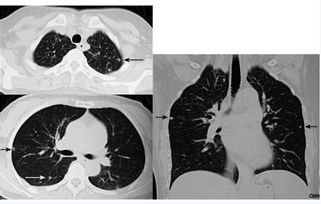 肺部纖維灶注意事項