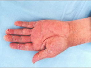 注意事項,癬菌疹