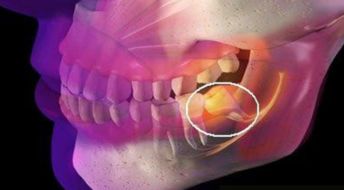 拔理智牙注意事項,拔智齒后的注意事項及飲食,拔智牙之后注意事項與禁忌癥