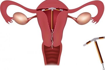 上環(huán),門(mén)診,術(shù)前,注意事項