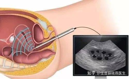 移植動(dòng)胚前注意事項