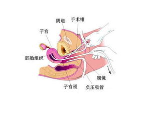 產(chǎn)后刮宮后注意事項