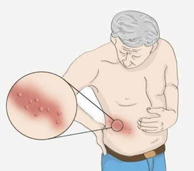 注意事項,飲食,蛇盤(pán)瘡