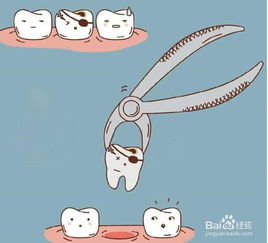 拔大牙前注意事項