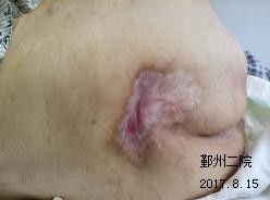 預防壓瘡的注意事項,壓瘡換藥的注意事項,壓瘡的護理要點(diǎn)及注意事項