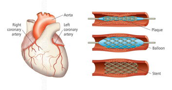心臟病手術(shù)后注意事項