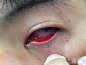 結膜炎注意事項和如何恢復,結膜炎一般多久能好結膜炎注意事項,結膜炎日常注意事項