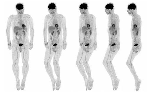 pectct檢查前注意事項