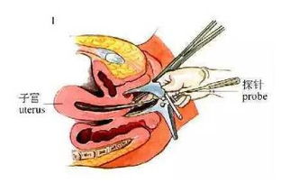 注意事項,節育環(huán)