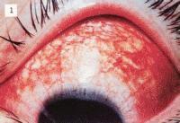 結膜炎注意事項好大夫在線(xiàn)