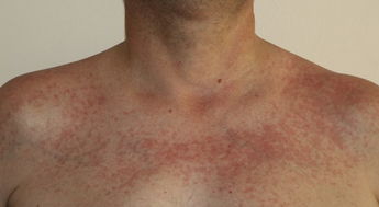 頭頸部放療的注意事項,放療前后的注意事項,放療注意事項乳腺癌